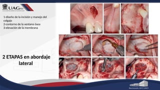 2 ETAPAS en abordaje
lateral
1-diseño de la incisión y manejo del
colgajo
2-contorno de la ventana ósea
3-elevación de la membrana
 
