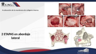 2 ETAPAS en abordaje
lateral
4-colocación de la membrana de colágeno interna
 