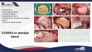 2 ETAPAS en abordaje
lateral
5-injerto óseo
6-materiales de injerto
7-mezcla de injerto
8-colocación de injerto
9-colocación de membrana de colágeno
externa
10-cierre de tejidos blandos
 