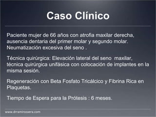 Caso Clínico
Paciente mujer de 66 años con atrofia maxilar derecha,
ausencia dentaria del primer molar y segundo molar.
Neumatización excesiva del seno .
Técnica quirúrgica: Elevación lateral del seno maxilar,
técnica quirúrgica unifásica con colocación de implantes en la
misma sesión.
Regeneración con Beta Fosfato Tricálcico y Fibrina Rica en
Plaquetas.
Tiempo de Espera para la Prótesis : 6 meses.
www.drramirozaera.com
 