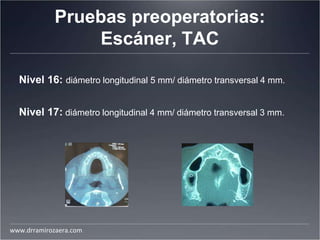 Pruebas preoperatorias:
Escáner, TAC
Nivel 16: diámetro longitudinal 5 mm/ diámetro transversal 4 mm.
Nivel 17: diámetro longitudinal 4 mm/ diámetro transversal 3 mm.
www.drramirozaera.com
 