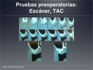 Pruebas preoperatorias:
Escáner, TAC
www.drramirozaera.com
 