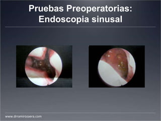 Pruebas Preoperatorias:
Endoscopia sinusal
www.drramirozaera.com
 