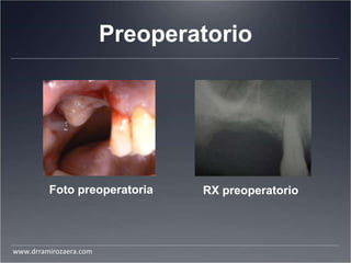 Preoperatorio
Foto preoperatoria RX preoperatorio
www.drramirozaera.com
 