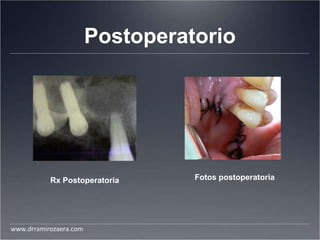Postoperatorio
Fotos postoperatoriaRx Postoperatoria
www.drramirozaera.com
 