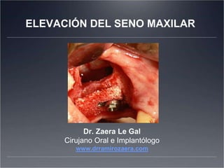 ELEVACIÓN DEL SENO MAXILAR
Dr. Zaera Le Gal
Cirujano Oral e Implantólogo
www.drramirozaera.com
 