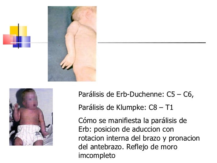erb duchenne