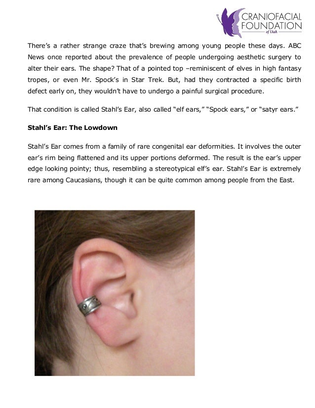 ‘Elf’ Ears A Look at Stahl’s Deformity