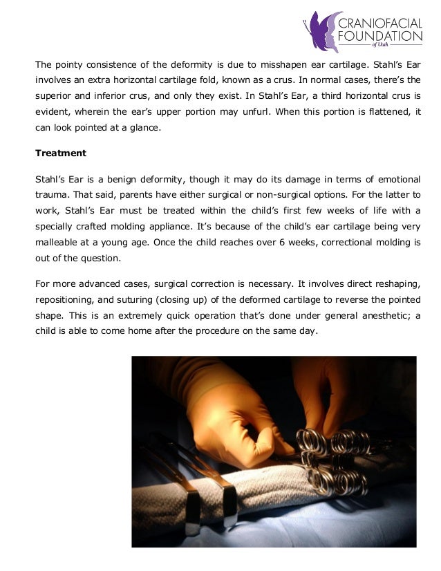 ‘Elf’ Ears A Look at Stahl’s Deformity