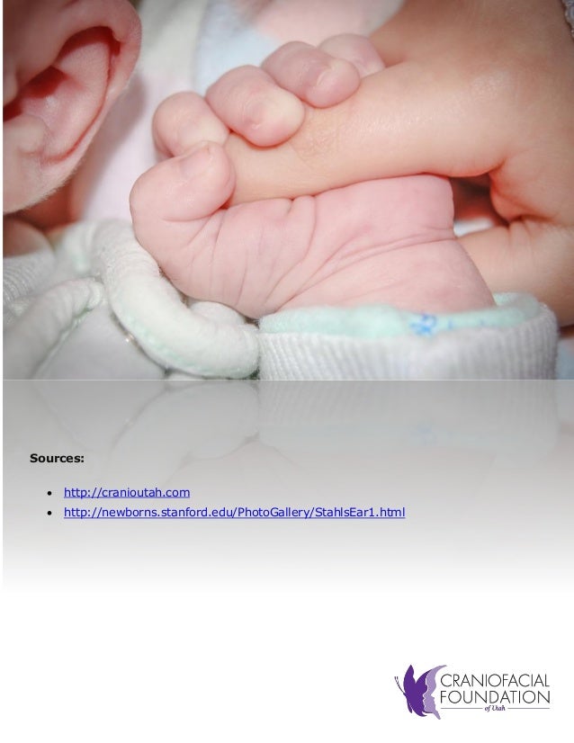 ‘Elf’ Ears A Look at Stahl’s Deformity