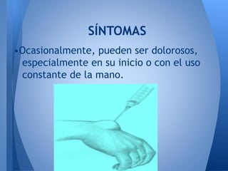 SÍNTOMAS
•Ocasionalmente, pueden ser dolorosos,
 especialmente en su inicio o con el uso
 constante de la mano.
 