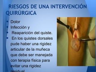 RIESGOS DE UNA INTERVENCIÓN
QUIRÚRGICA
•   Dolor
•   Infección y
•    Reaparición del quiste.
•    En los quistes dorsales
    pude haber una rigidez
    articular de la muñeca
    que debe ser manejada
    con terapia física para
    evitar una rigidez
 