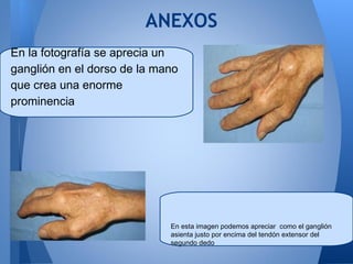 ANEXOS
En la fotografía se aprecia un
ganglión en el dorso de la mano
que crea una enorme
prominencia




                             En esta imagen podemos apreciar como el ganglión
                             asienta justo por encima del tendón extensor del
                             segundo dedo
 