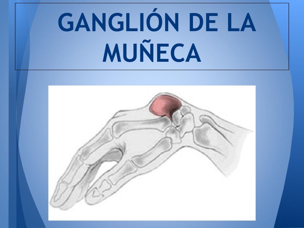 El ganglion muneca