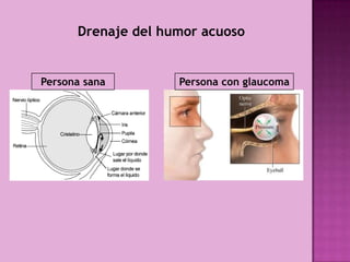 Drenaje del humor acuoso


Persona sana        Persona con glaucoma
 