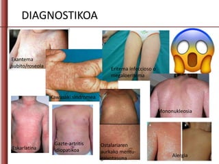 DIAGNOSTIKOA
Exantema
subito/roseola
Kawasaki sindromea
Eritema infeccioso o
megaloeritema
Mononukleosia
Eskarlatina
Gazte-artritis
idiopatikoa
Ostalariaren
aurkako mentu-
gaixotasuna
Alergia
 