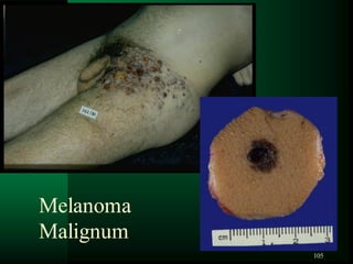 105
Melanoma
Malignum
 