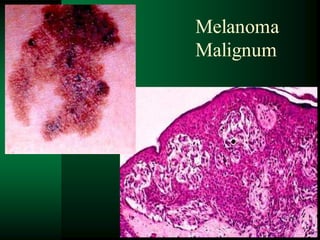 106
Melanoma
Malignum
 