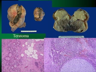 109
Teratoma
 