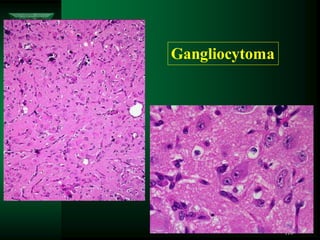 110
Gangliocytoma
 