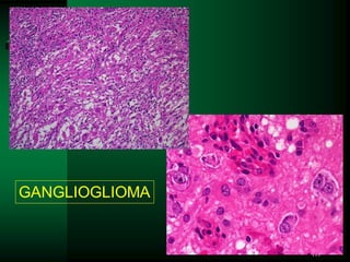 111
GANGLIOGLIOMA
 