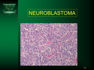 112
NEUROBLASTOMA
 