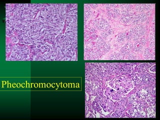 113
Pheochromocytoma
 