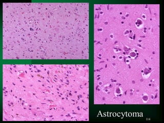 114
Astrocytoma
 