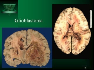 115
Glioblastoma
 