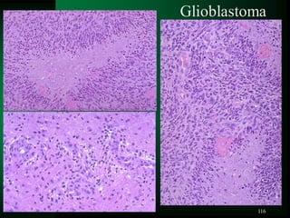 116
Glioblastoma
 