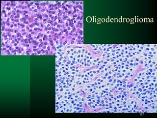 117
Oligodendroglioma
 