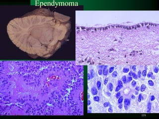 119
Ependymoma
 
