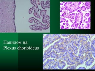 121
Папилом на
Plexus chorioideus
 
