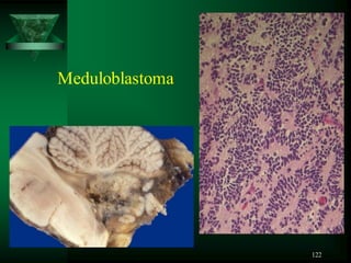 122
Meduloblastoma
 