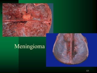 123
Meningioma
 