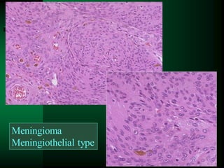 125
Meningioma
Meningiothelial type
 