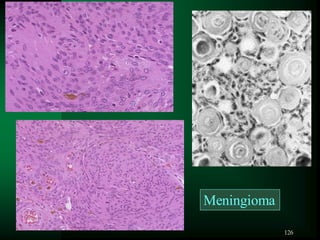 126
Meningioma
 