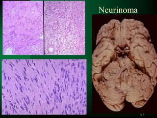 127
Neurinoma
 