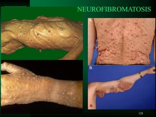 128
NEUROFIBROMATOSIS
 