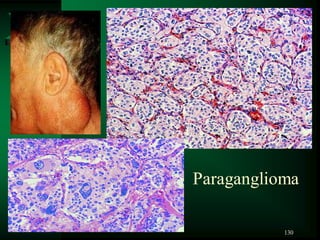 130
Paraganglioma
 