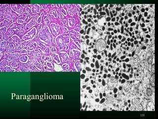 131
Paraganglioma
 