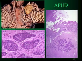 133
APUD
 