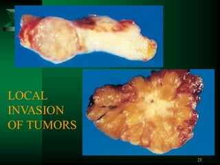 23
LOCAL
INVASION
OF TUMORS
 
