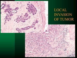 24
LOCAL
INVASION
OF TUMOR
 