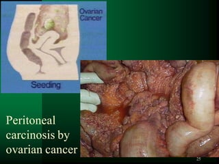 25
Peritoneal
carcinosis by
ovarian cancer
 