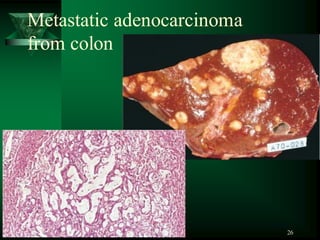 26
Metastatic adenocarcinoma
from colon
 