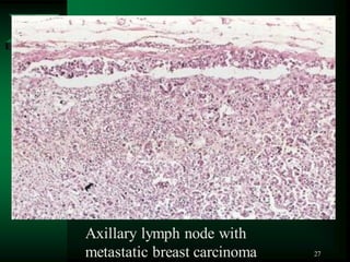 27
Axillary lymph node with
metastatic breast carcinoma
 
