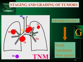 29
STAGING AND GRADING OF TUMORS
TNM
DIFFERENTIATION
•well
•moderate
•low (poor)
G
 