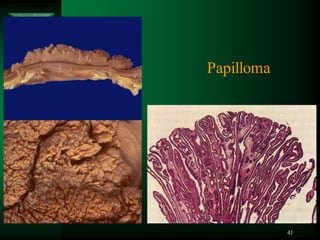 41
Papilloma
 