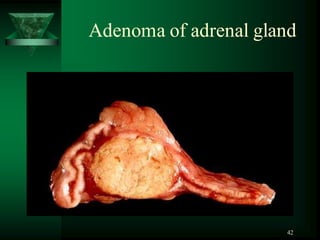 42
Adenoma of adrenal gland
 